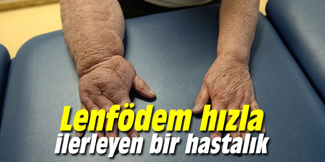 Dikkat! Lenfödem hızla ilerleyen bir hastalık