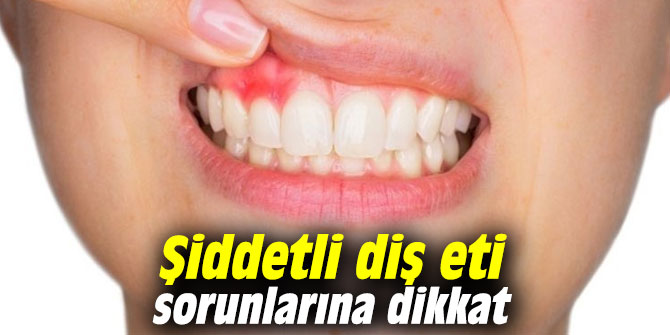 Şiddetli diş eti sorunlarına dikkat