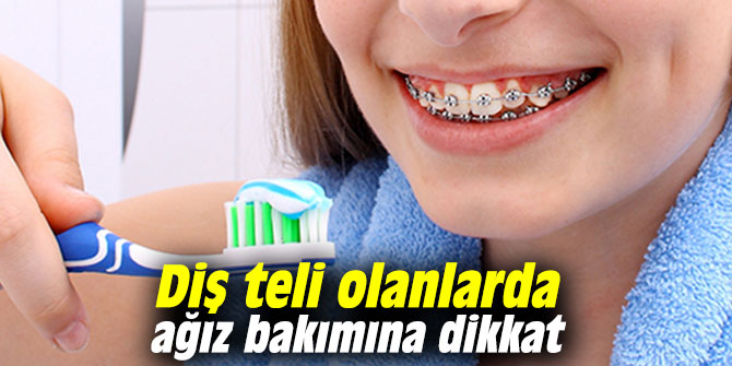 Diş teli olanlarda ağız bakımına dikkat