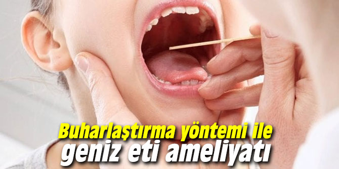 Buharlaştırma yöntemi ile geniz eti ameliyatı mümkün!