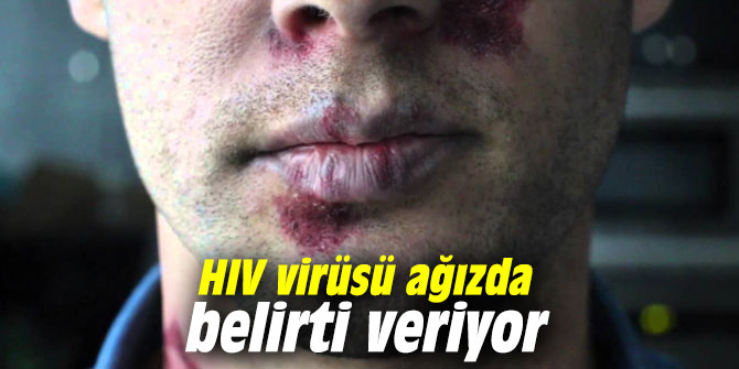 Hiv Virusu Agizda Belirti Veriyor