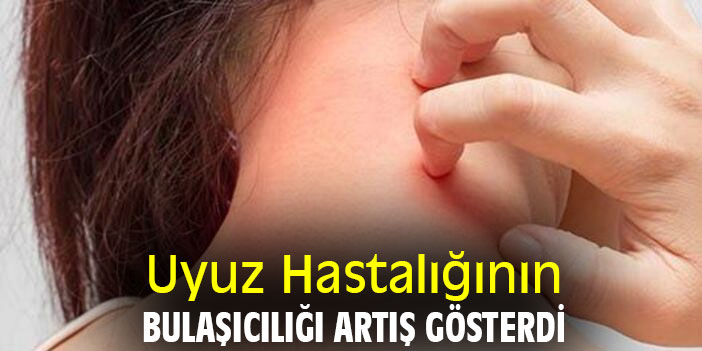 Uyuz Hastalığının Bulaşıcılığı Artış Gösterdi