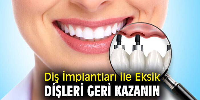Diş İmplantları ile Eksik Dişlerinizi tamamlayın!