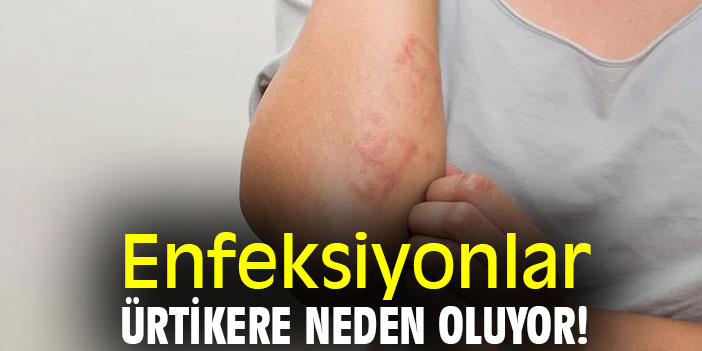 Enfeksiyonlar, ürtikere neden oluyor!