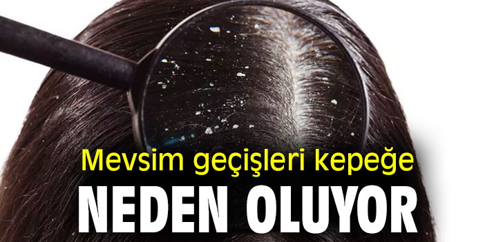 Mevsim geçişleri kepeğe neden oluyor