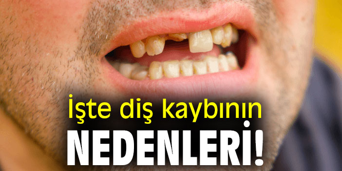 İşte diş kaybının nedenleri!