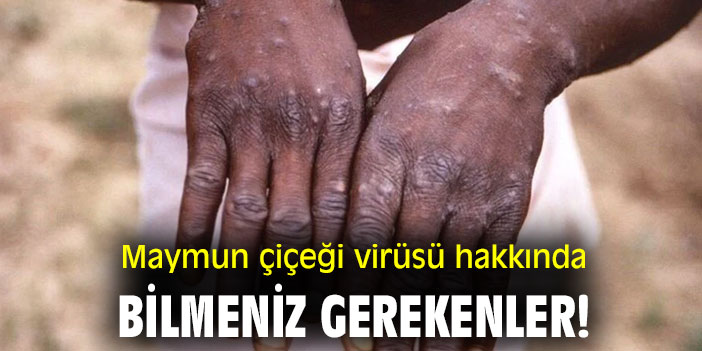 Maymun çiçeği virüsü hakkında bilmeniz gerekenler!