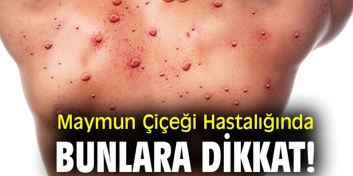 Maymun Çiçeği Hastalığında Bunlara dikkat!