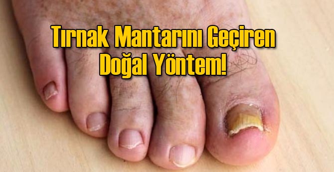 Tırnak Mantarını Geçiren Doğal Yöntem!