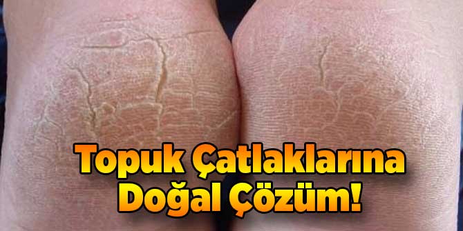 Topuk Çatlaklarına Doğal Çözüm!