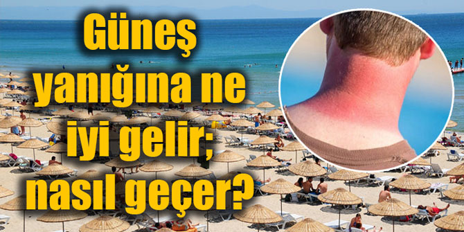 Güneş yanığına ne iyi gelir; nasıl geçer?