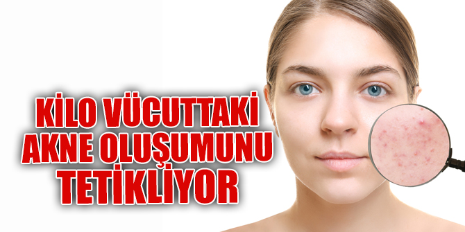 Kilo vücuttaki akne oluşumunu tetikliyor