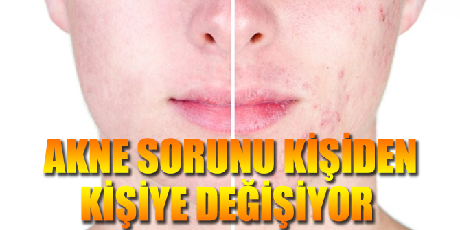 Akne sorunu kişiden kişiye değişiyor