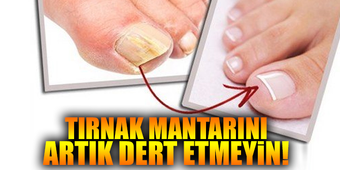 Tırnak mantarını kafanıza takmayın