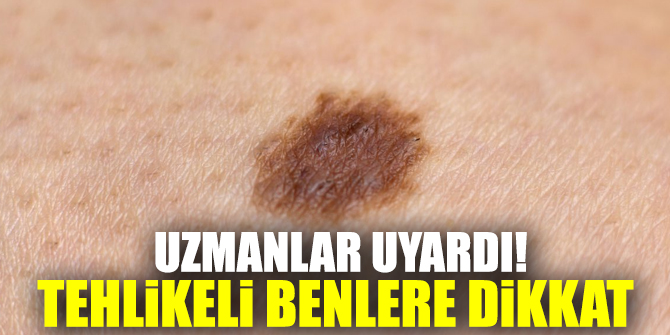 Uzmanlar uyardı! Tehlikeli benlere dikkat