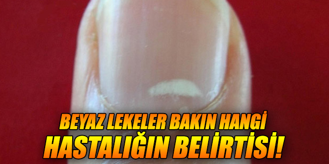 Beyaz lekeler bakın hangi hastalığın belirtisiymiş!
