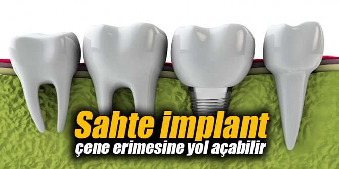 Sahte implant çene erimesine yol açabilir