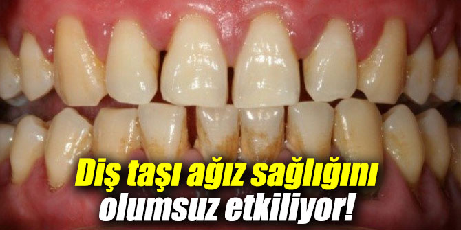 Diş taşı ağız sağlığını olumsuz etkiliyor!