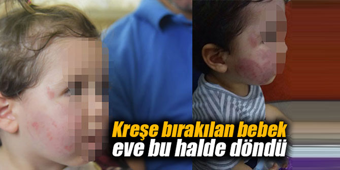 Kreşe bırakılan bebek eve bu halde döndü