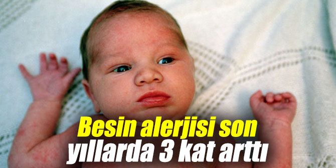 Besin alerjisi son yıllarda 3 kat arttı