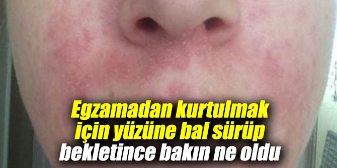 Egzamadan kurtulmak için yüzüne bal sürüp bekletince bakın ne oldu