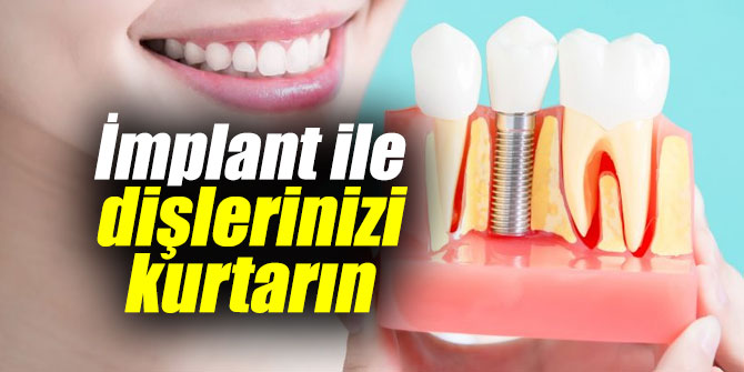 İmplant ile dişlerinizi kurtarın