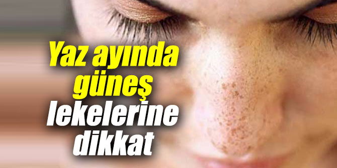 Yazın güneş lekelerine dikkat