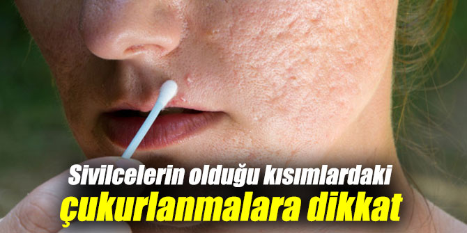 Sivilcelerin olduğu kısımlardaki çukurlanmalara dikkat