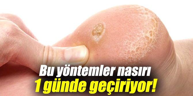 Bu yöntemler nasırı 1 günde geçiriyor!