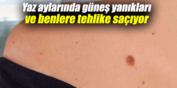 Yaz aylarında güneş yanıkları ve benlere tehlike saçıyor