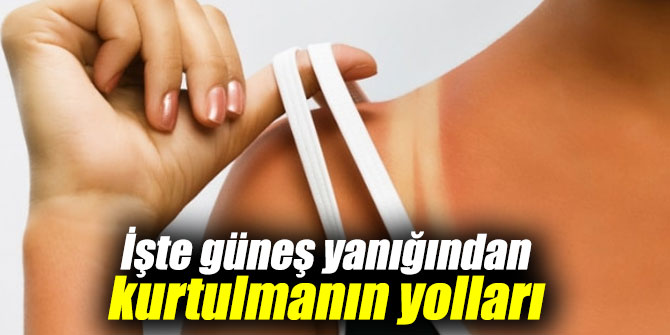 İşte güneş yanığından kurtulmanın yolları