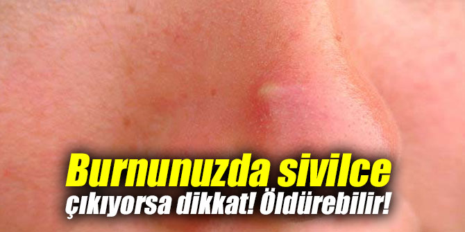 Burnunuzda sivilce çıkıyorsa dikkat! Öldürebilir!