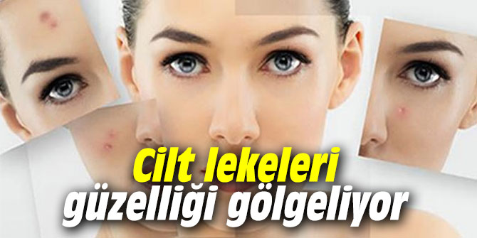 Cilt lekeleri güzelliği gölgeliyor
