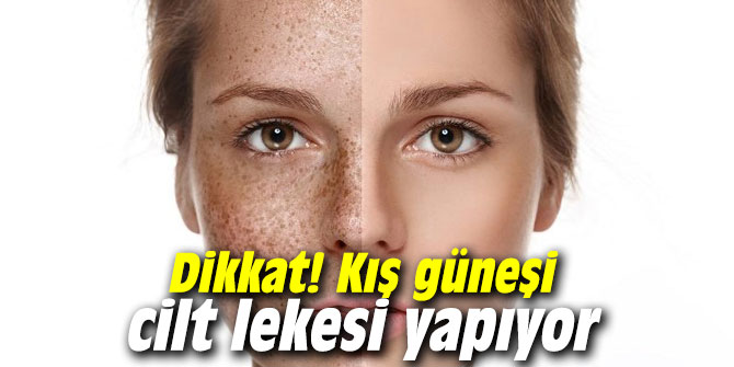 Dikkat! Kış güneşi de cilt lekesi yapıyor