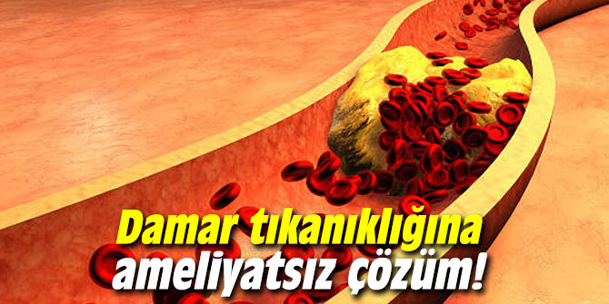 Damar tıkanıklığına ameliyatsız çözüm!