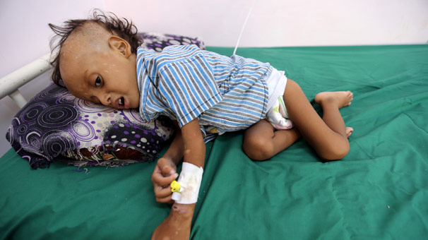 Yemen'de 85 bin çocuk açlıktan öldü!