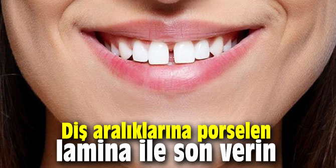 Diş aralıklarına porselen lamina ile son verin